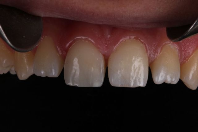 Clínica Dental San Vicente tratamientos de estética dental