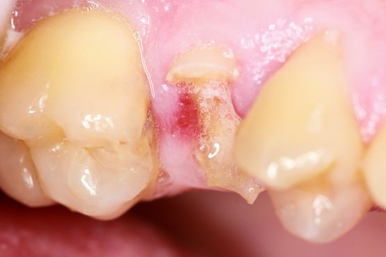 Clínica Dental San Vicente muela dañada