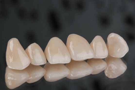 Clínica Dental San Vicente carillas dentales