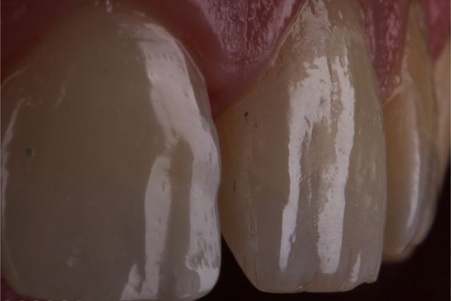Clínica Dental San Vicente estética en dientes