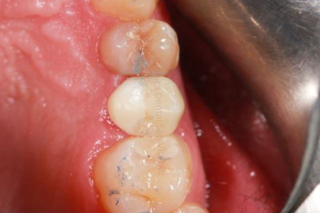 Clínica Dental San Vicente endodoncia