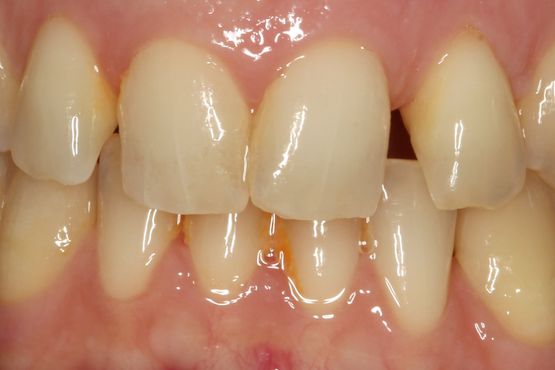 Clínica Dental San Vicente dientes torcidos