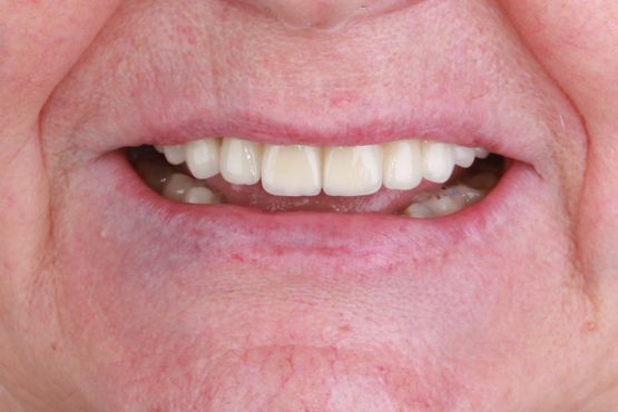Clínica Dental San Vicente implantes dentales