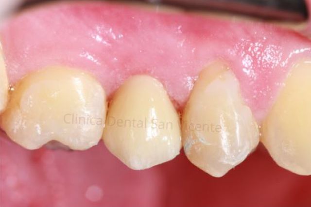 Clínica Dental San Vicente endodoncia real