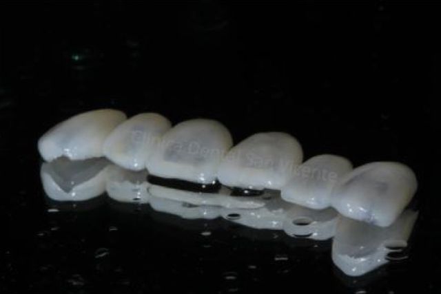Clínica Dental San Vicente carillas