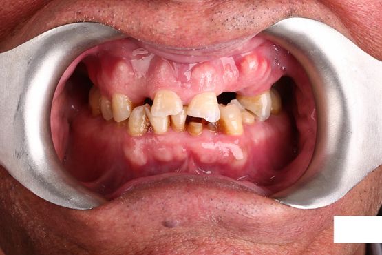 Clínica Dental San Vicente prótesis en los dientes