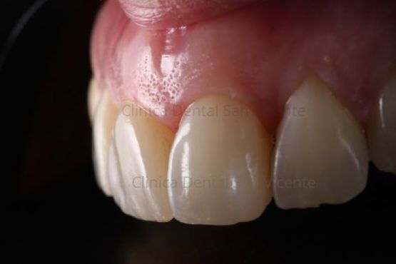 Clínica Dental San Vicente estética dental
